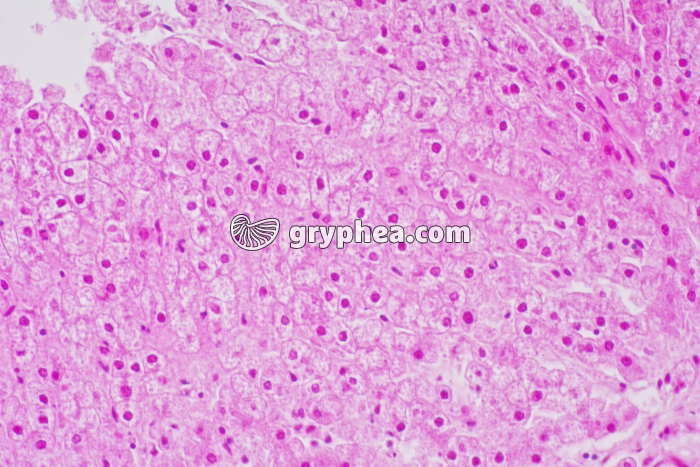 Foie diabétique stéatose x100 - gryphea.org